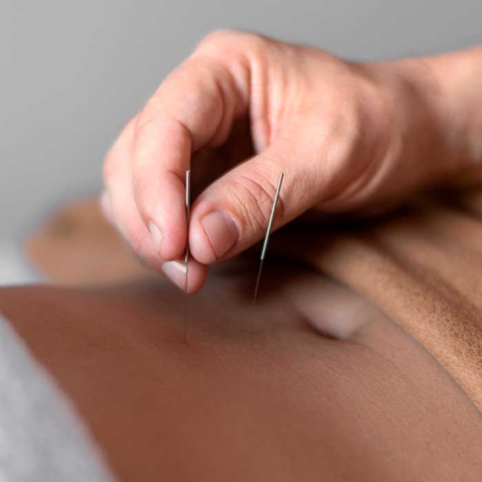 Acupuntura a Caldes Montbui